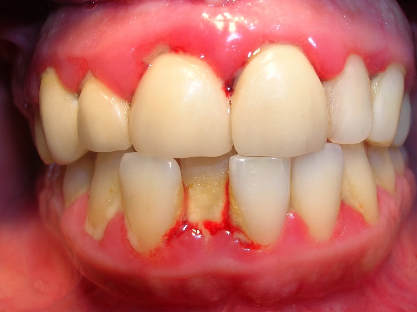 tác hại của vôi răng đến sức khỏe răng miệng