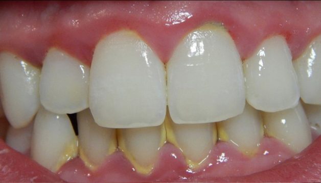 vôi răng hình thành như thế nào